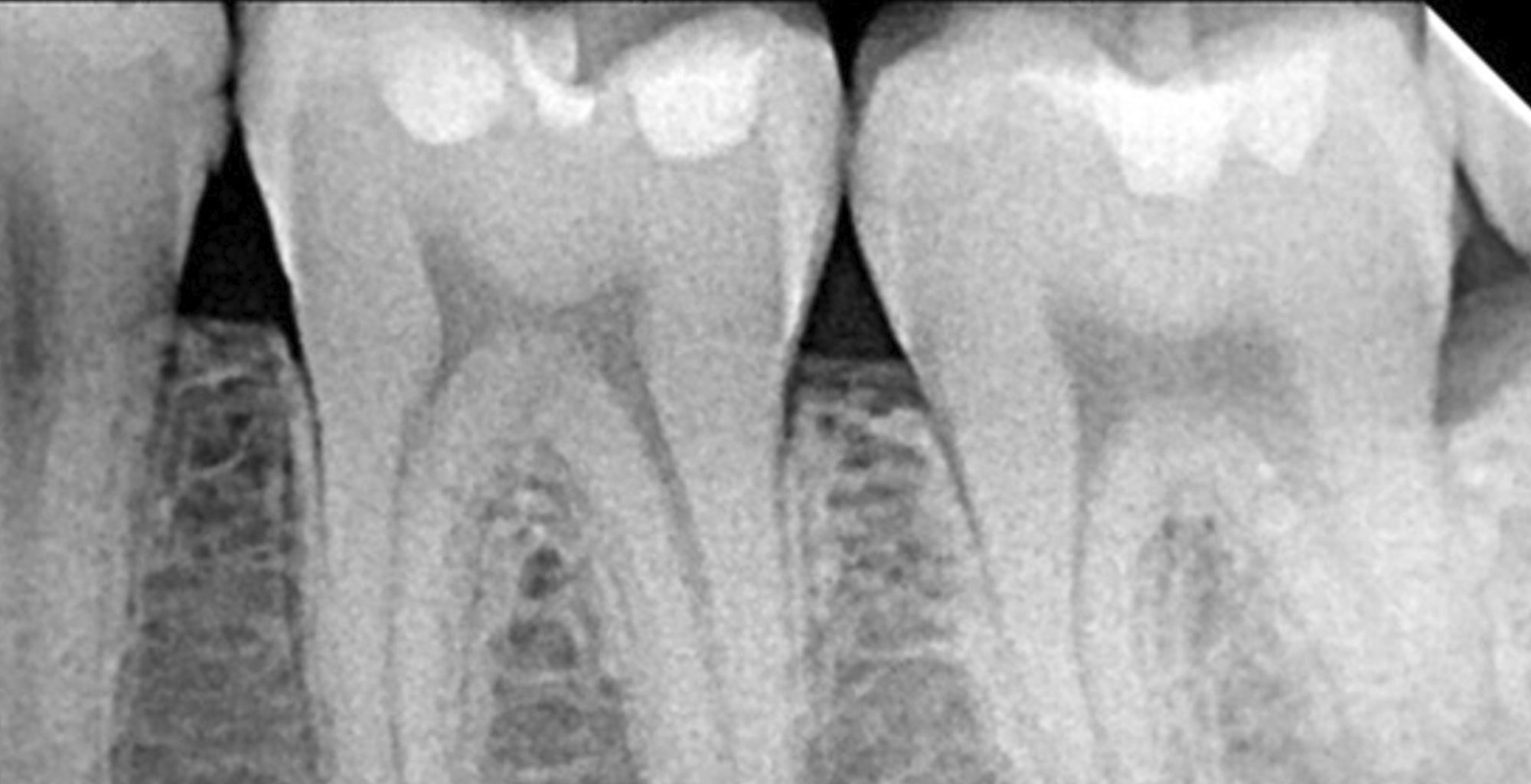 RX Periapical Digital DentixRay